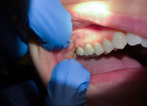 Best Lost Filling or Crown Replacement in Erath, LA